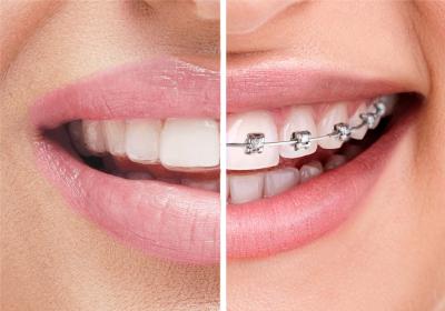 Braces & Aligners in Mallepally