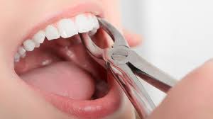 Tooth Extraction in Mallepally