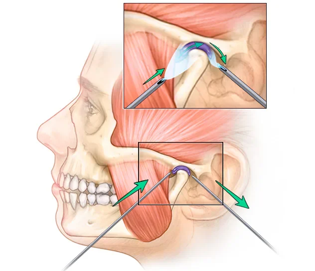 TMJ Disorder Treatment in Malleally